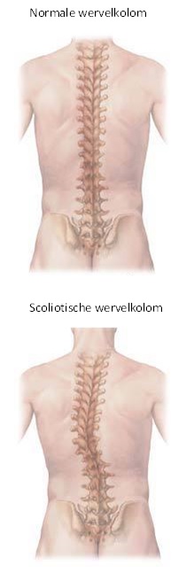 Scoliose en beenlengteverschil